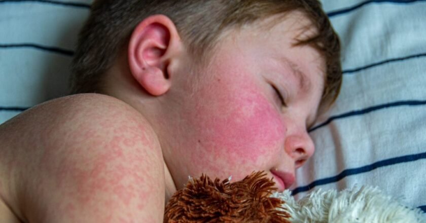 Measles Outbreaks in the U.S. Highlight the Importance of Vaccination