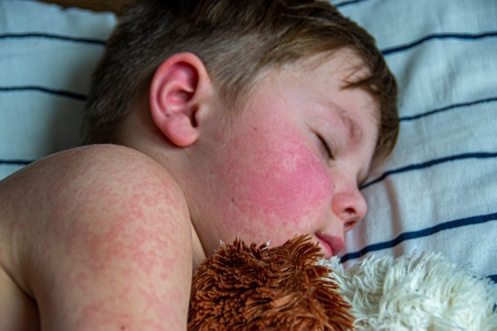 Measles Outbreaks in the U.S. Highlight the Importance of Vaccination
